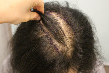 수술 전 심을 부위 체크 입니다