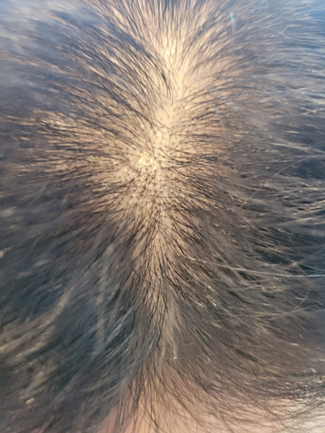 1년 정면으로 가르마 밀도 사진입니다