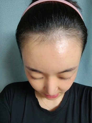 수술전