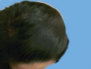 수술3일째 
