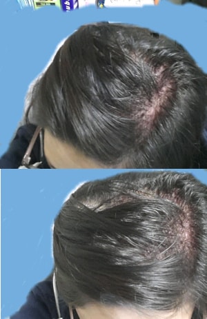 수술3일째 오늘 첫 샴푸후