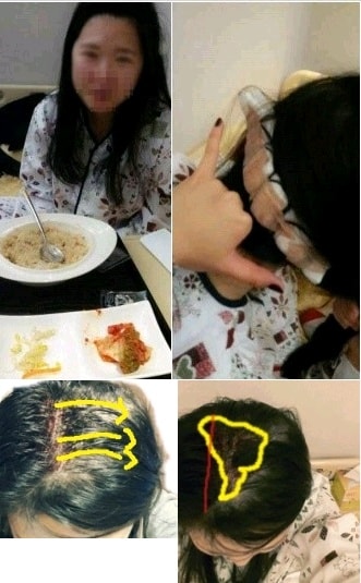 수술당일 절개부위,수술직후