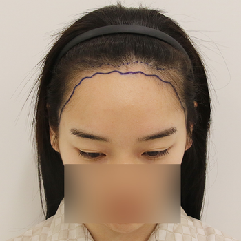 수술 전 디자인 앞