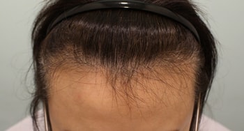 아래 : 모발이식 수술 8개월