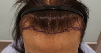 위에 : 모발이식 수술 전