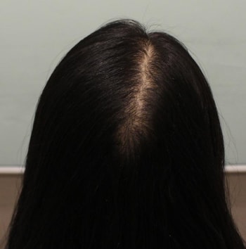 뒤쪽 탈모(수술 전