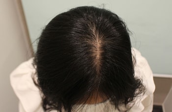 가르마 수술전-7개월 비교