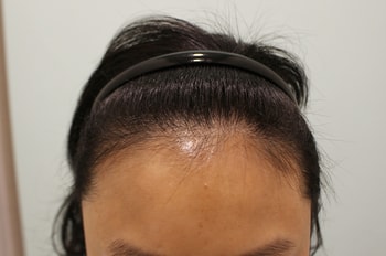 헤어라인 수술전 - 7개월 비교