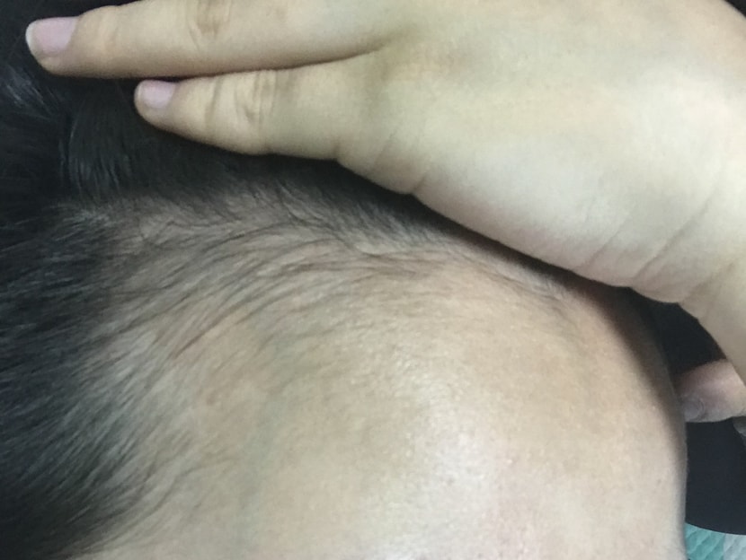 로게인폼하기전 오른쪽헤어라인
