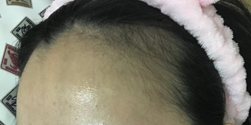 로게인폼한후 왼쪽헤어라인