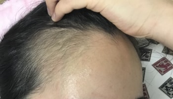 로게인폼한후 오른쪽 해어라인