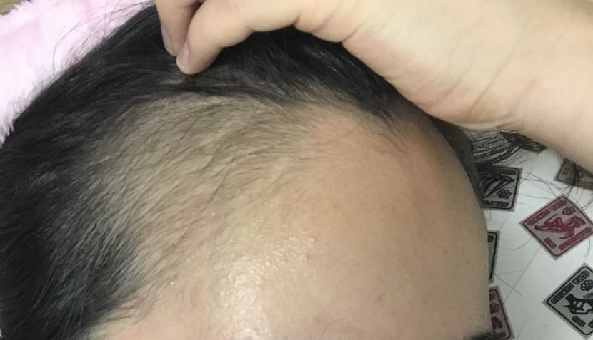 로게인폼한후 오른쪽 해어라인