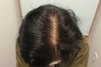 수술 후 1년 측면 가르마