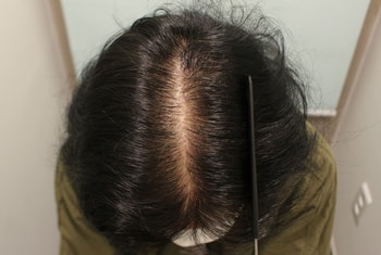 수술 후 1년 정중앙 가르마