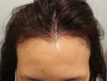 수술하고서 바로 찍은 사진