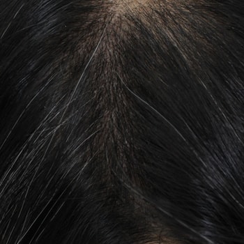 가름마 이식 10일 후