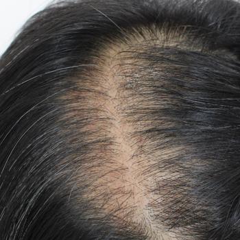 가름마 이식 1달