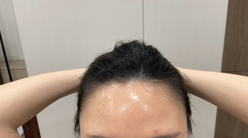 주사 시술 후