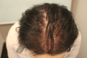 수술한 부위 이구요