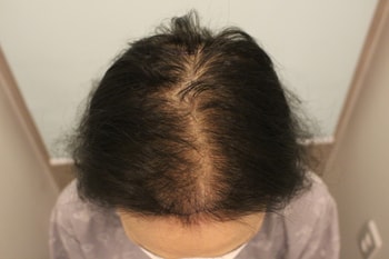 수술전 앞과 위의 모습 입니다