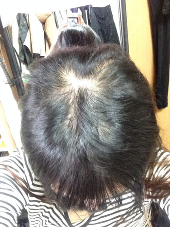 이식 185일째 정수리 