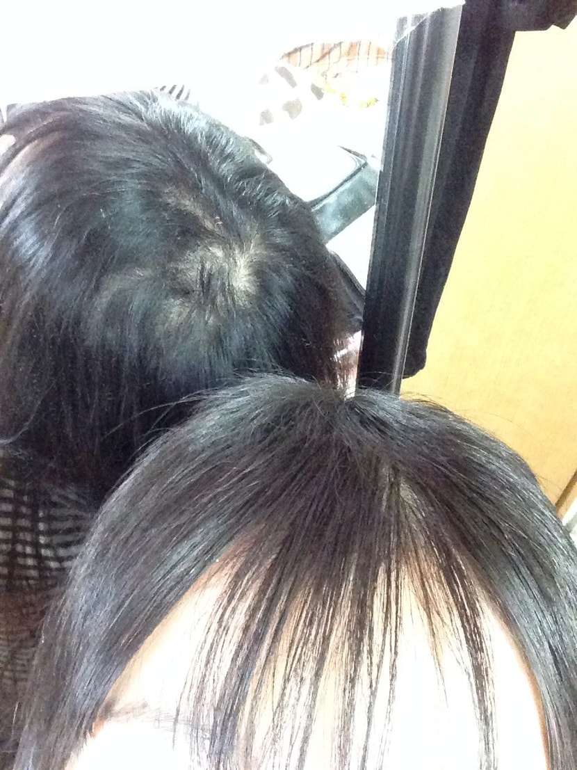이식 185일째 옆모습 