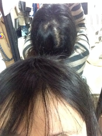 이식 185일째 뒷모습