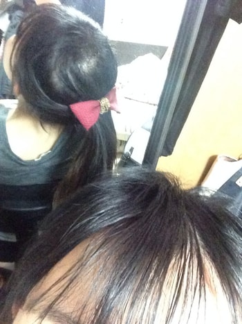 이식 후 218일 현재