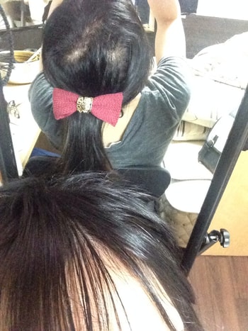 이식 후 218일 현재 