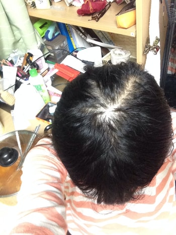 이식 후 218일 현재