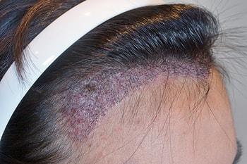 10일 차 - 딱지제거 후