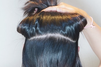 10일 차 - 비절개 무삭발 모낭 채취부위 - 대박