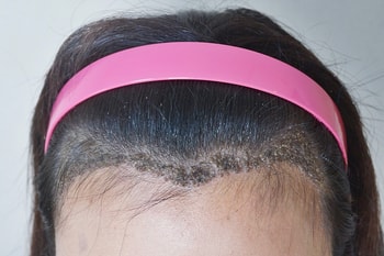 10일 차 - 딱지제거 전