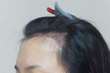비절개 이식 1일차