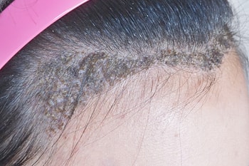 10일 차 - 딱지제거 전