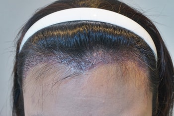 10일 차 - 딱지제거 후