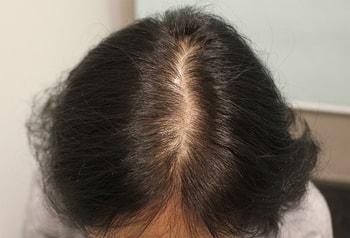 가르마ㅣ수술 전