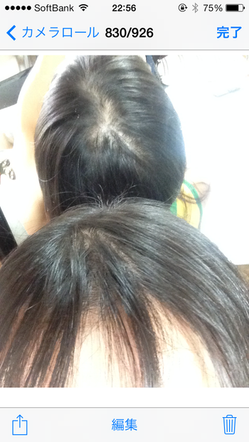 이식 전 정수리 사진