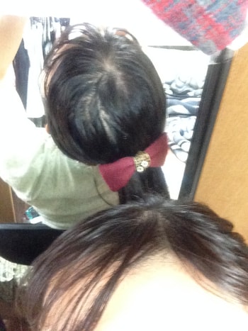 이식 후 밑으로 머리 묶은 사진