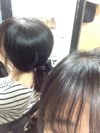 이식 전 밑으로 머리 묶은 사진