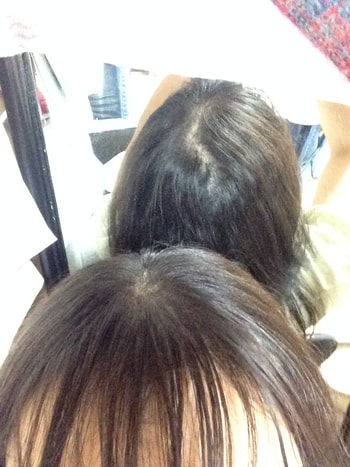 이식 후 정수리 사진