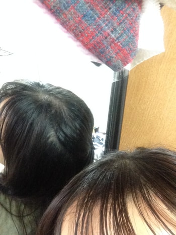 이식 후 반묶음 오른쪽 사진