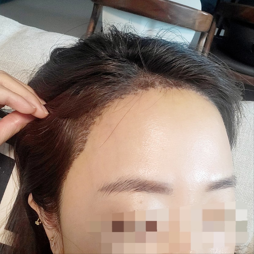 수술 후 1 주일