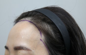 수술 전 디자인