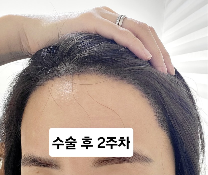 수술 후 2주일
