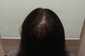 7개월 경과 위, 뒷모습