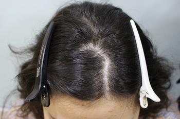 수술전 흉터부위