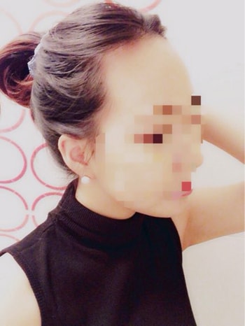 [수술전] 옆에서 찍은 사진