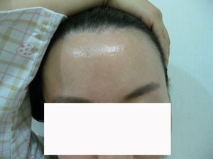 수술 전 정면 ! 나름 이마는 짱구인데 튀어나와서 더 넓어 보여요..