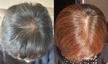 두피지방재생술 1년 후